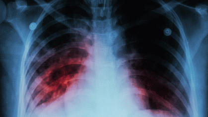 x-ray of infected lungs